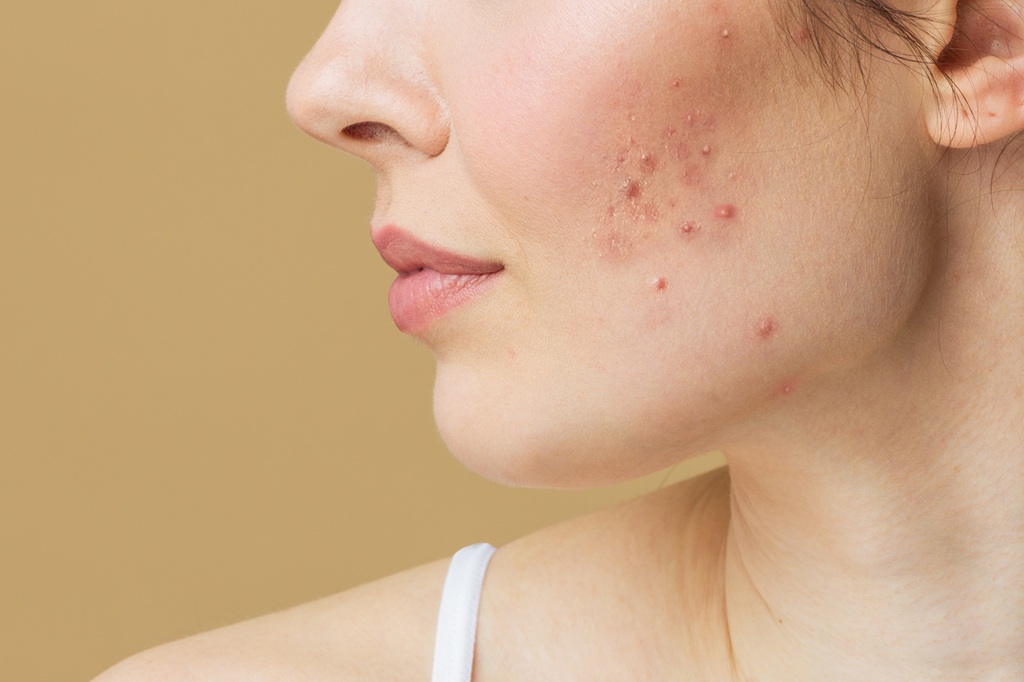 Acne Treatment in Islamabad