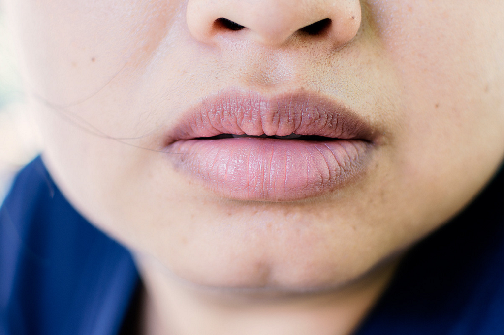 Dark Lips Treatment in Islamabad - Dr. Afsheen Bilal