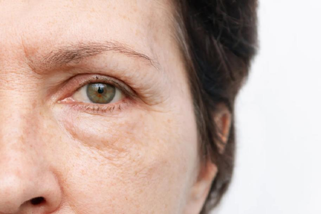 Eye Bag Treatment in Islamabad - Dr Afsheen Bilal