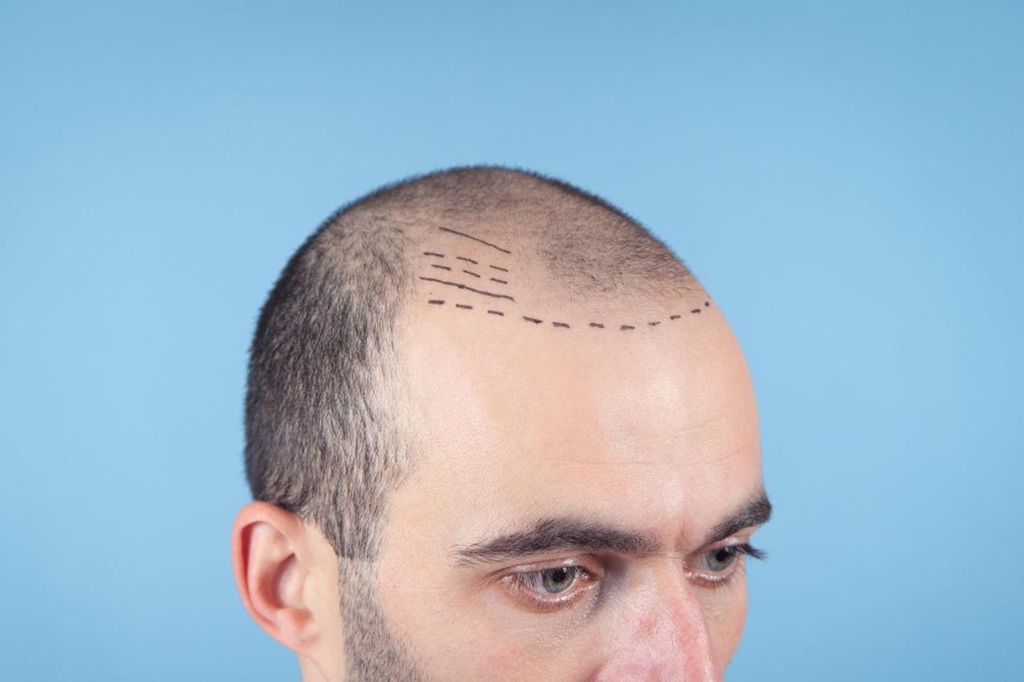 FUE hair transplant in Islamabad
