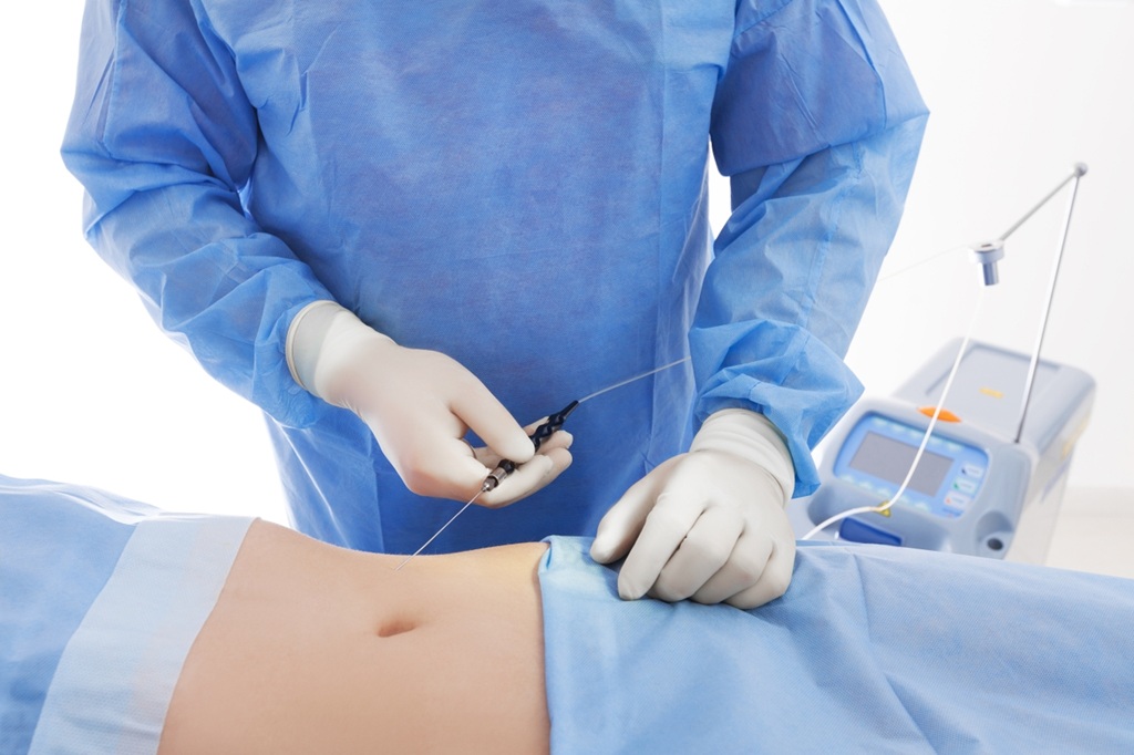 Liposuction Surgery in Islamabad