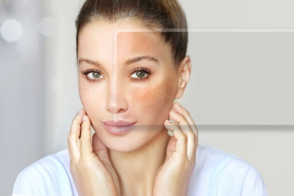 Melasma Treatment in islamabad