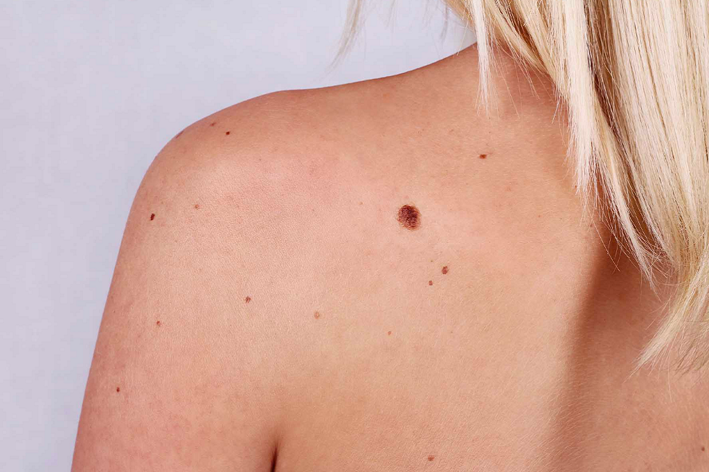 Mole Removal in Islamabad - Dr. Afsheen Bilal