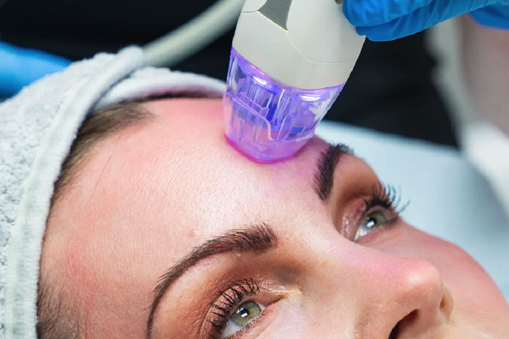 RF Microneedling in Islamabad - Dr. Afsheen Bilal