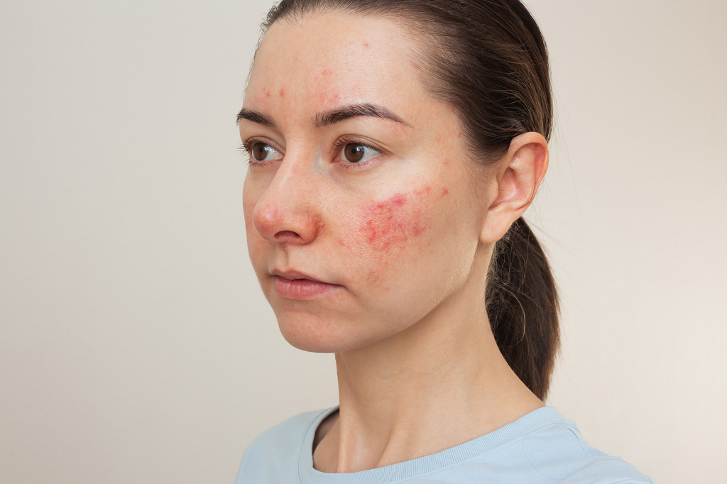 Rosacea Removal in Islamabad - Dr Afsheen Bilal
