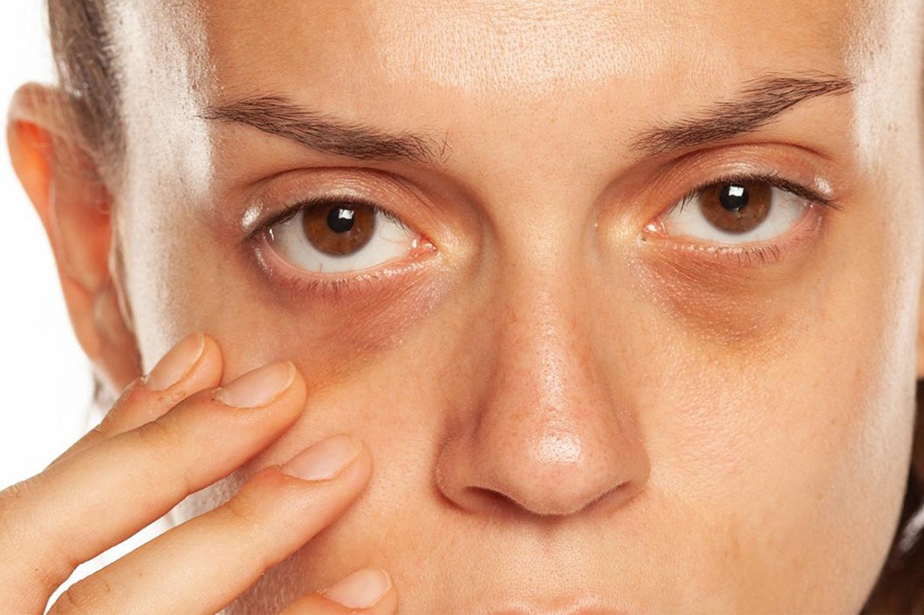 dark circle treatment in Islamabad