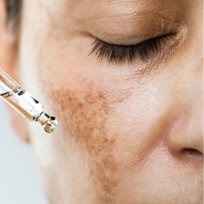 Best Treatment for Pigmentation on Face