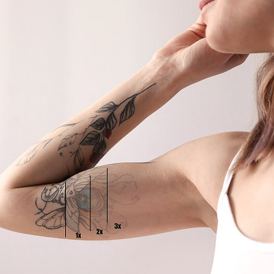 Can A Tattoo Be Fully Removed