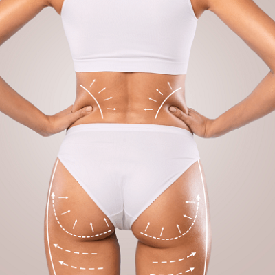 What Areas Can Be Treated with Liposuction