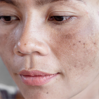 Best Treatment to Remove Dark Spots on Face