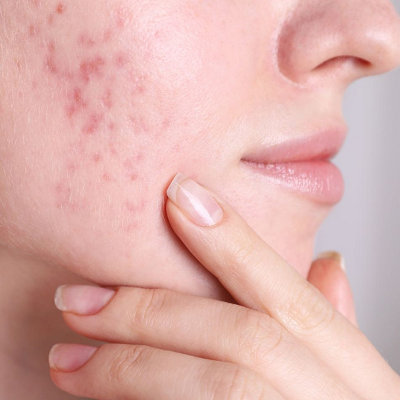 Do Hydrafacials Cause Breakouts