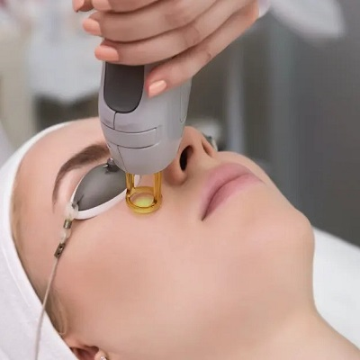 Most Effective Laser Treatment for Face