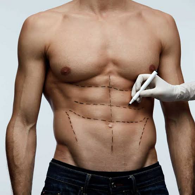 Can Laser Liposuction Help Define Abs?