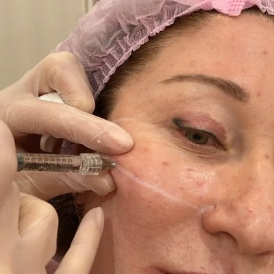 How Is Sculptra Different From Other Facial Fillers