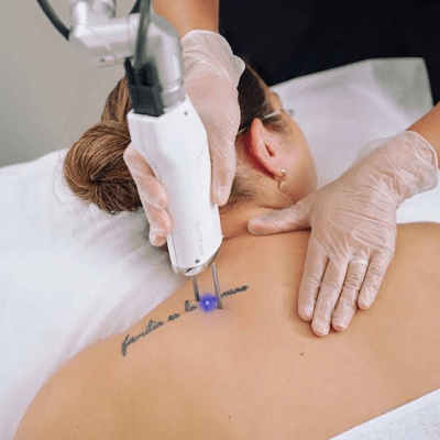 How Laser Tattoo Removal Can Restore Your Natural Skin