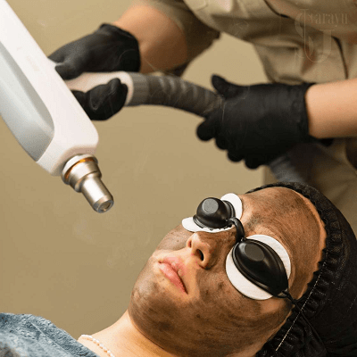 Say Goodbye to Acne and Dull Skin with Carbon Peels