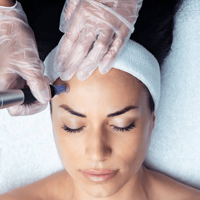 How Often to Get Microneedling?