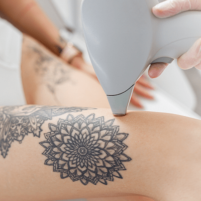 How Effective Is Tattoo Removal