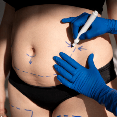 What Layer of Fat Is Removed During Liposuction?
