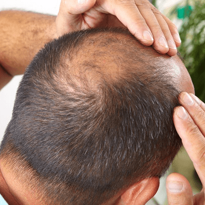 What to Expect Before and After a FUE Hair Transplant