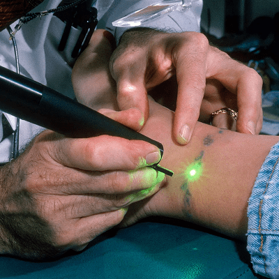 Does Tattoo Removal Hurt