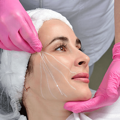 Thread Lift Benefits, Procedure, Recovery, and Results